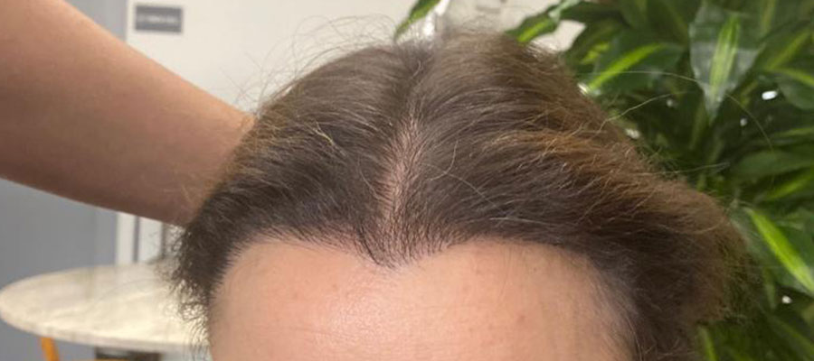 Direct Hair Implantation DHI - Hair Transplant in Istanbul with FUE + PRP +  Mesotherapy