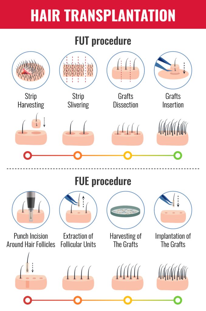 What are the differences of the FUE method?