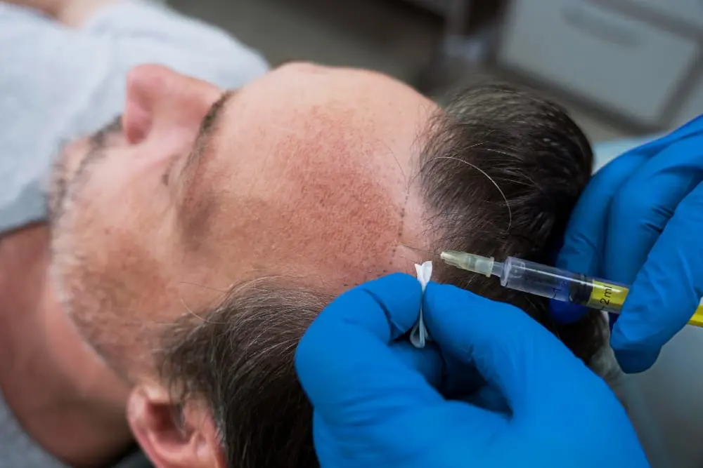 istanbul hair prp treatment