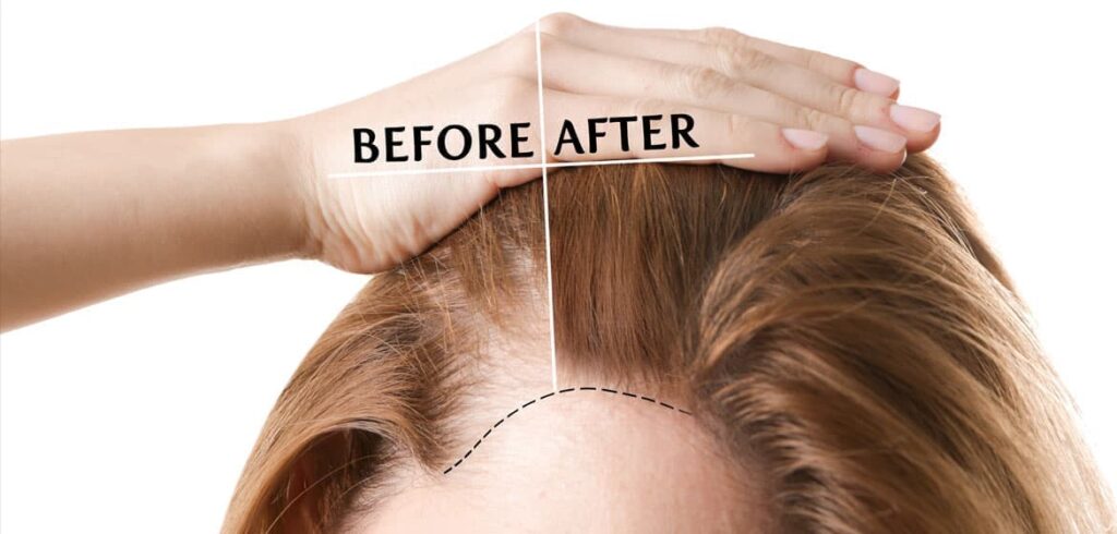 hair transplant menopause