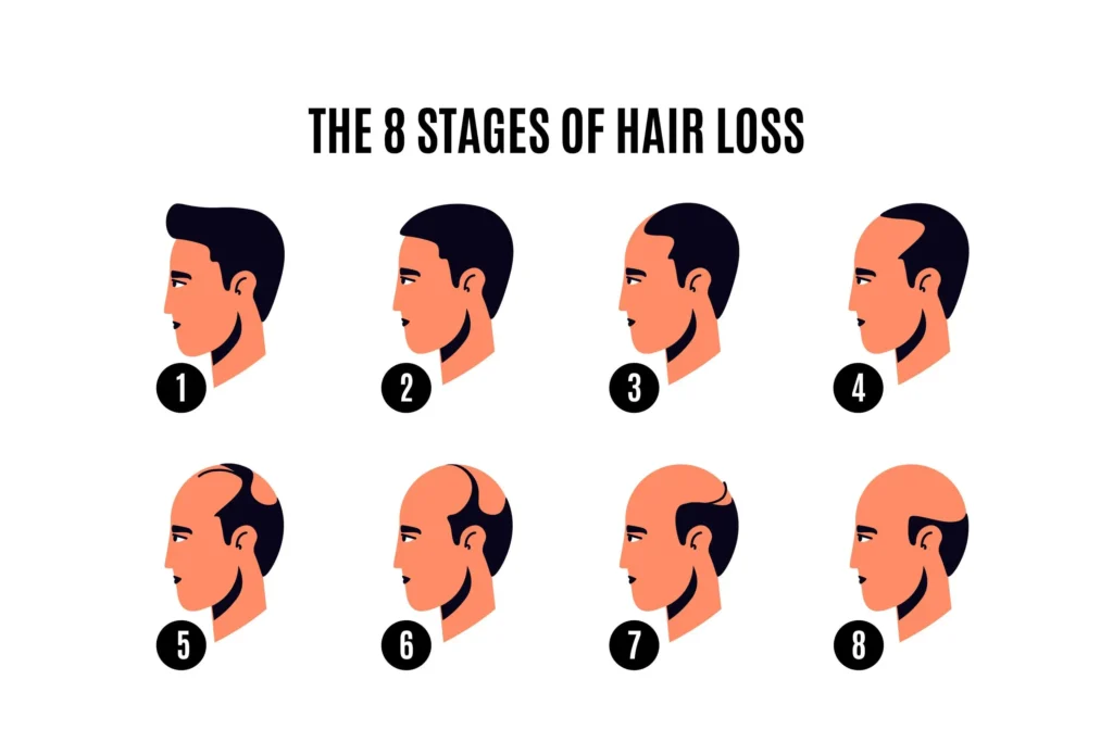 Stages of Male Pattern Hair Loss _