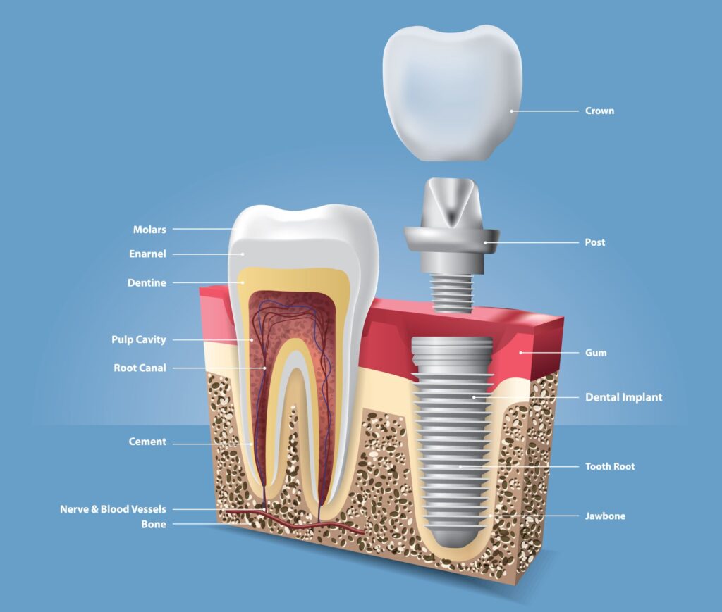 dental implant in istanbul