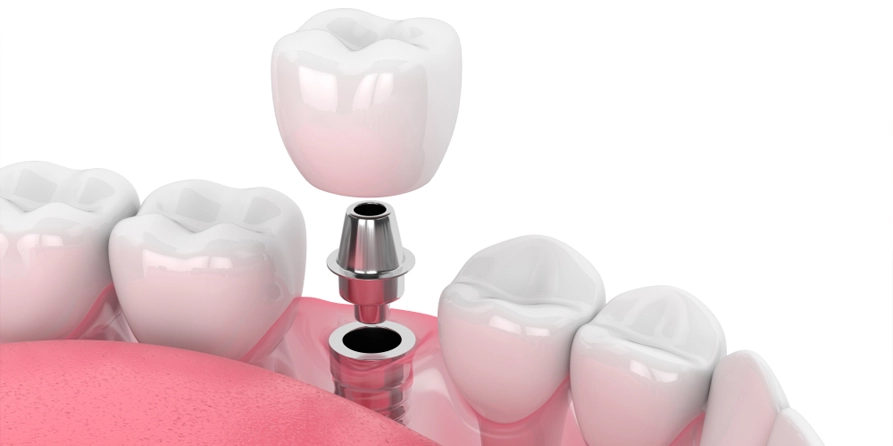 dental implants turkey