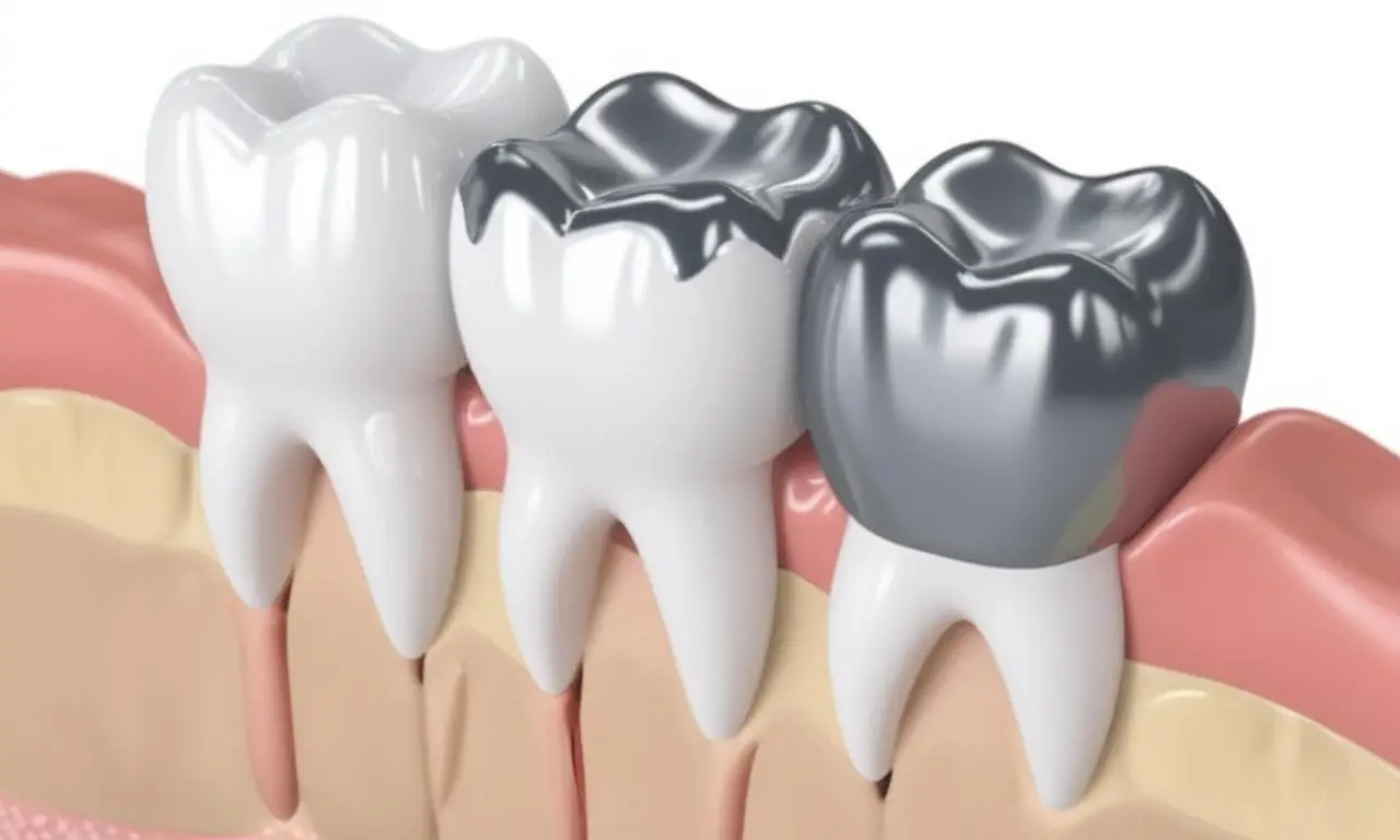 Amalgam vs. Composite Fillings: What’s the Difference and Why It Matters?